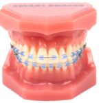 Smart-Braces-Blue