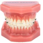 Smart-Braces-Clear