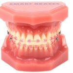 Smart-Braces-Pink
