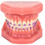 Smart-Braces-Purple
