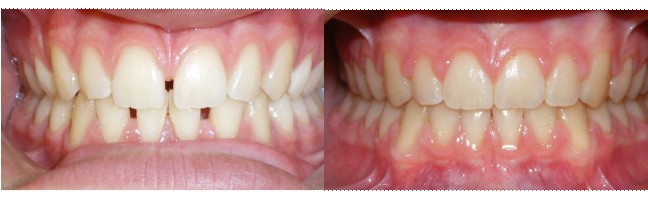 Before and After Mint Aligners Treatment closing gaps between teeth