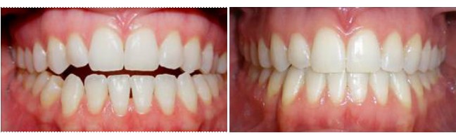 Before and after Aligner treatment for open bite using Mint Aligners