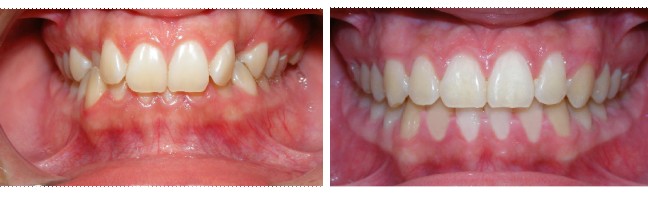 Before and After Mint Aligners treatment correcting deep overbite