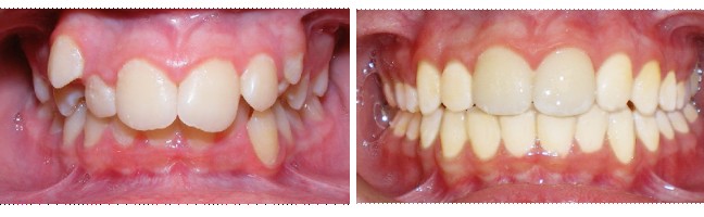 Before and after orthodontic treatment with Mint Aligners for crowded teeth